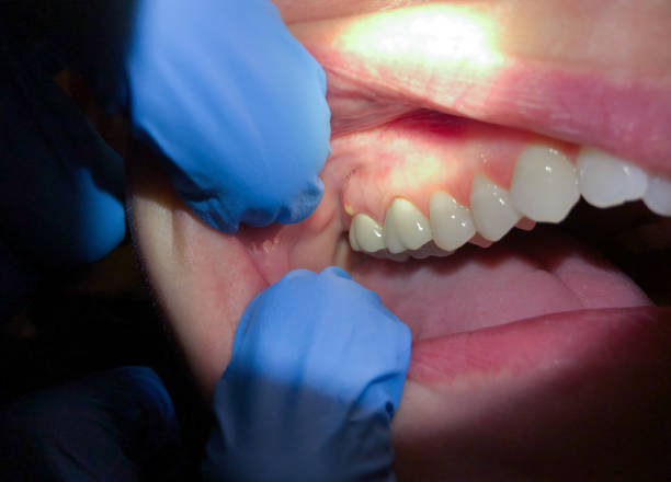 Best Emergency Tooth Extraction in Tipton, IN