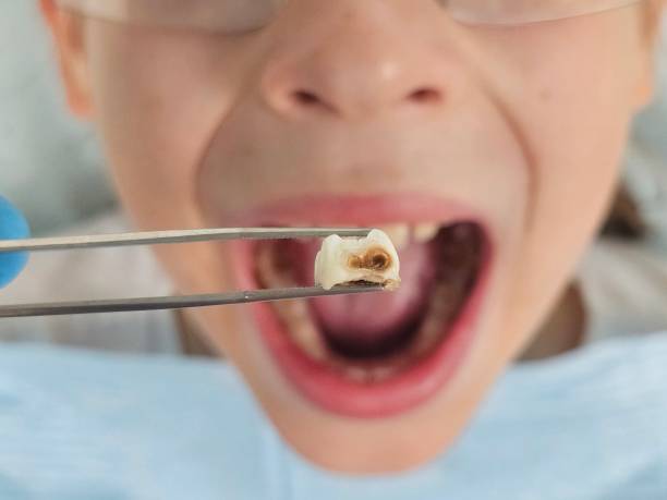 Best Emergency Root Canal Treatment in Tipton, IN